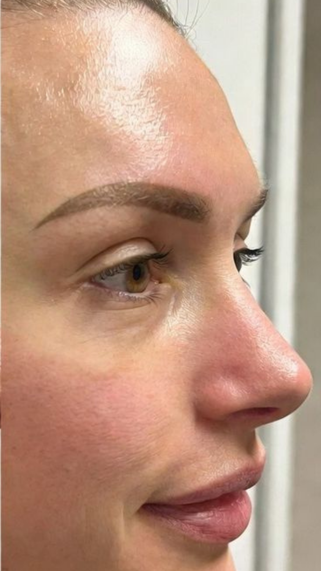 After injectables