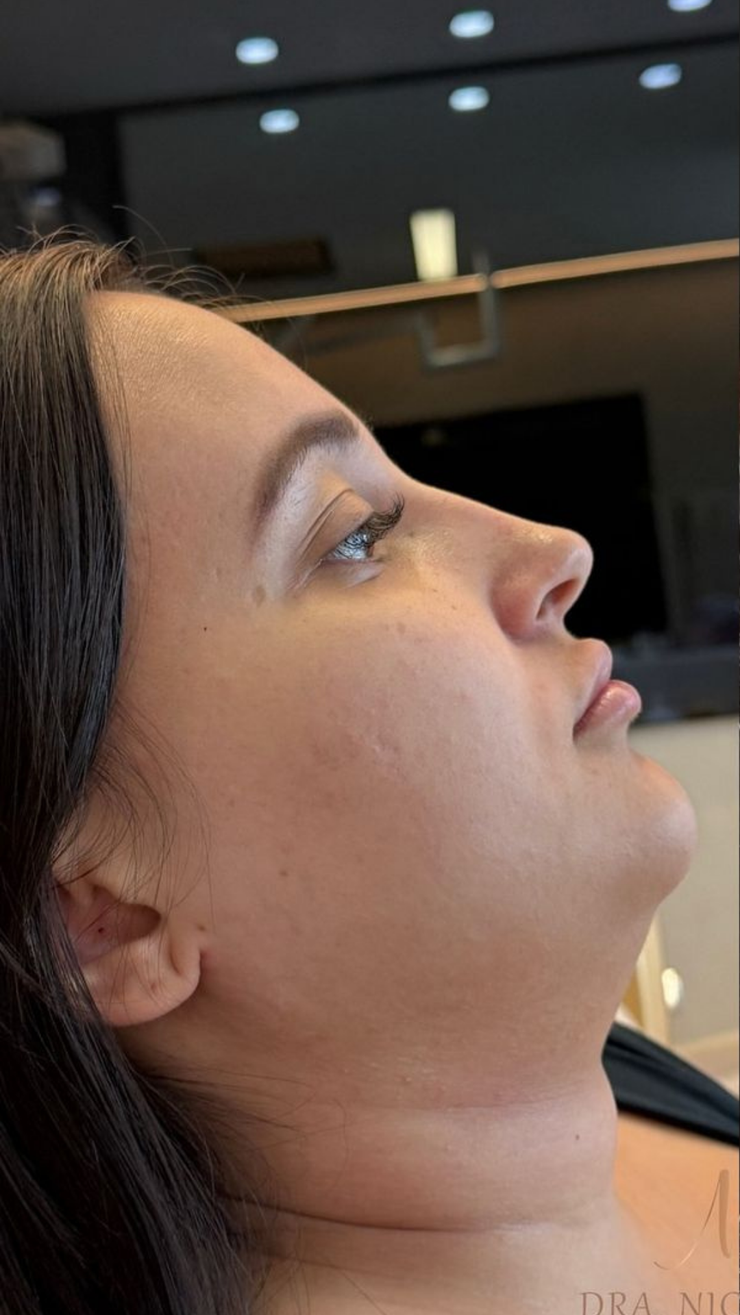 Before double chin removal