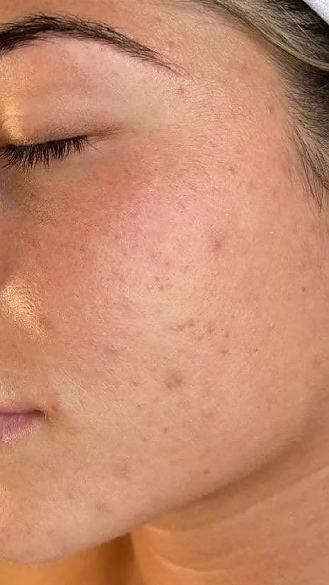 Before exosomes treatment