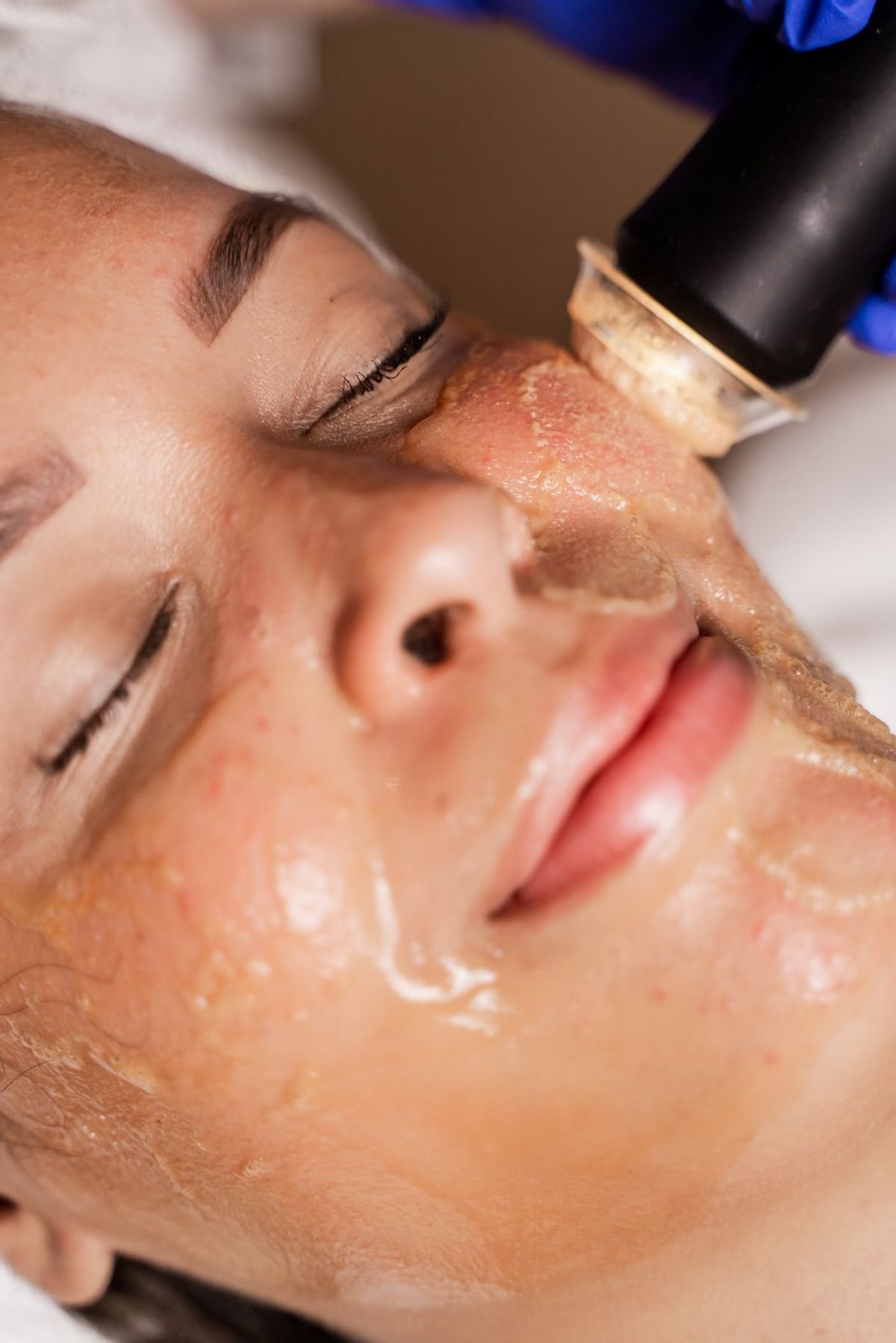 Oxygeneo Facial