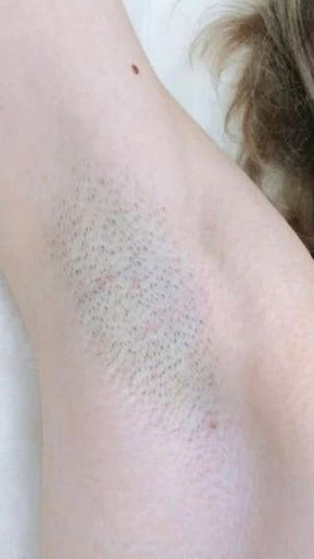 Before laser hair removal