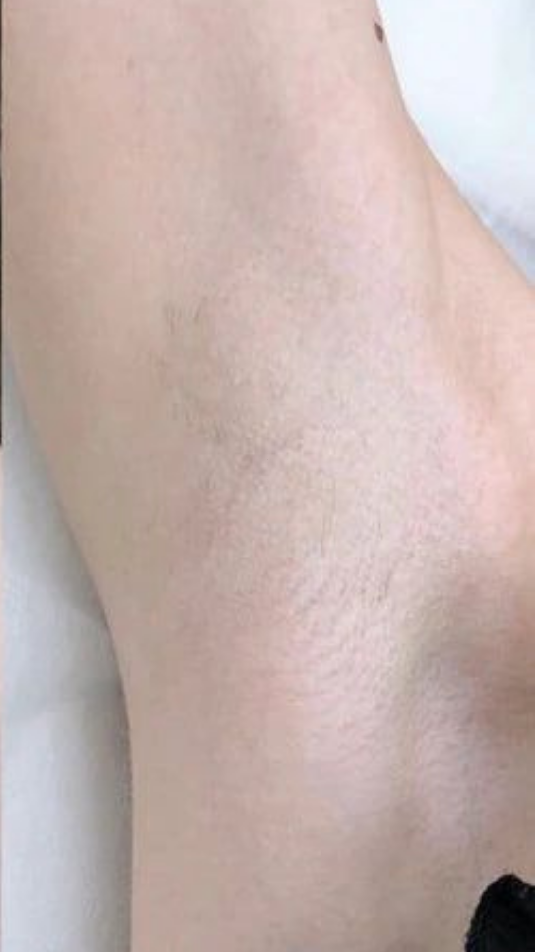 After laser hair removal