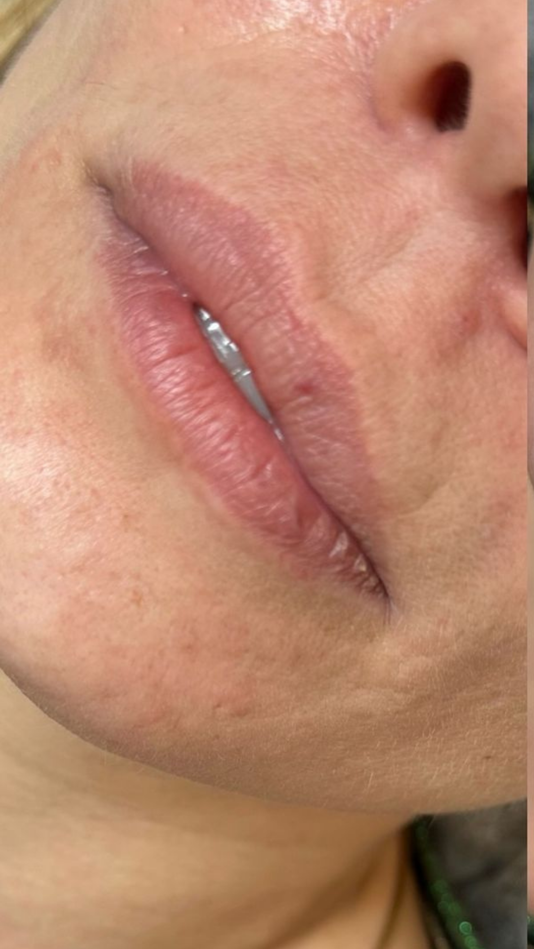 Before lip fillers