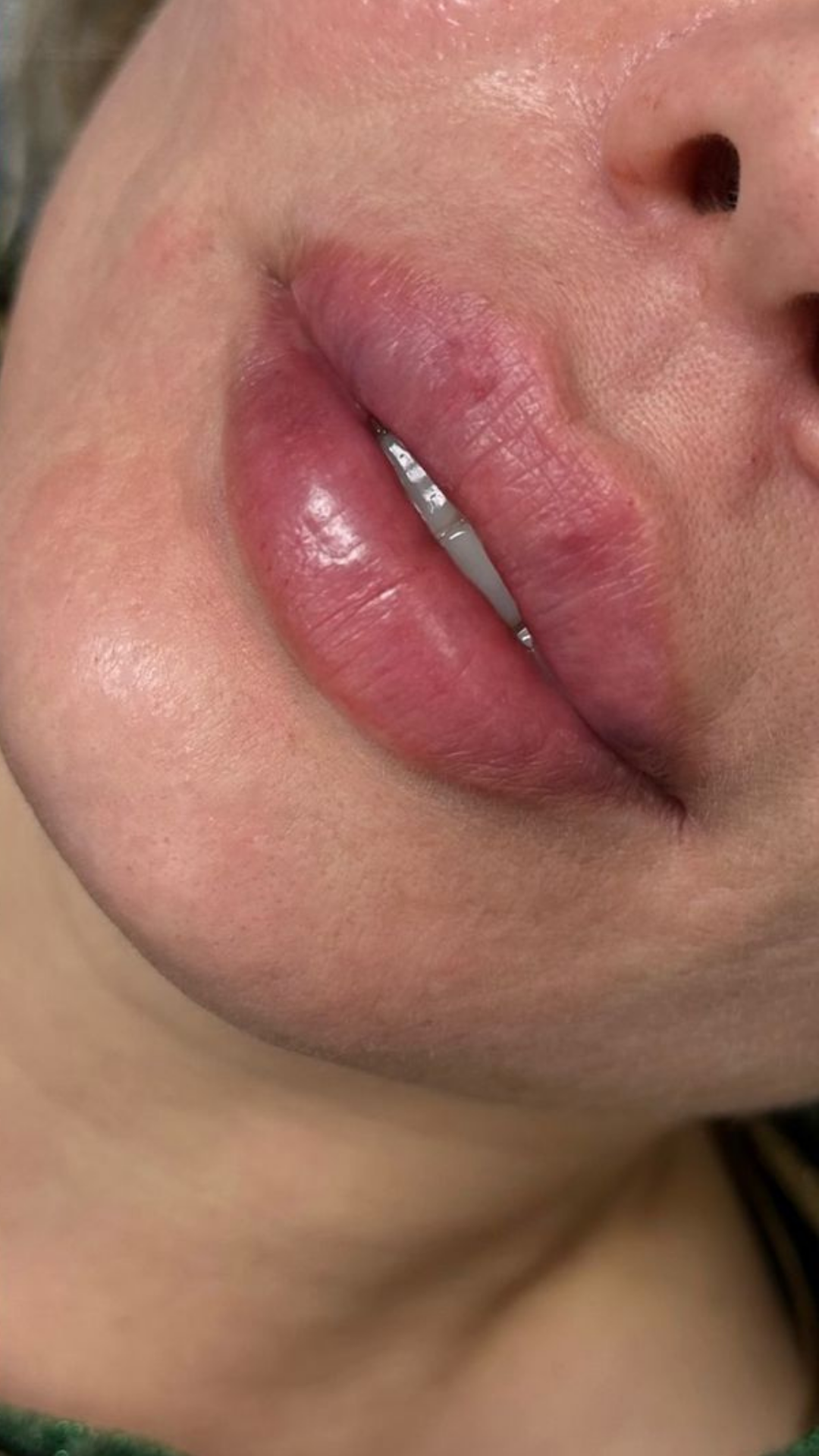 After lip fillers