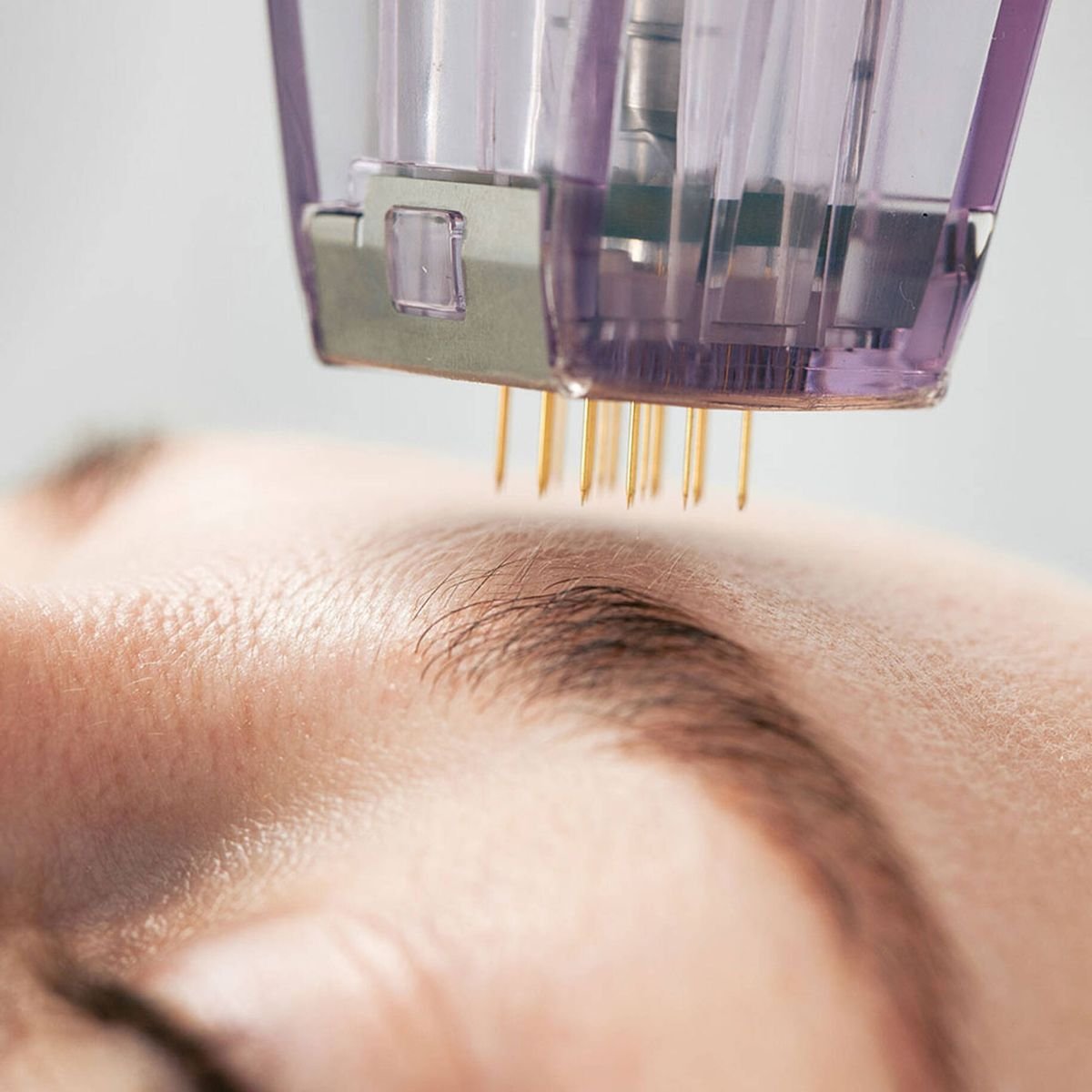 Microneedling
