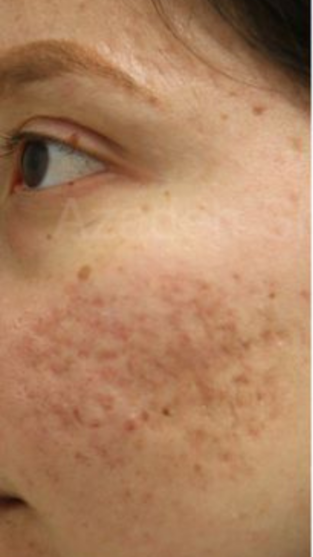 Before acne scar removal