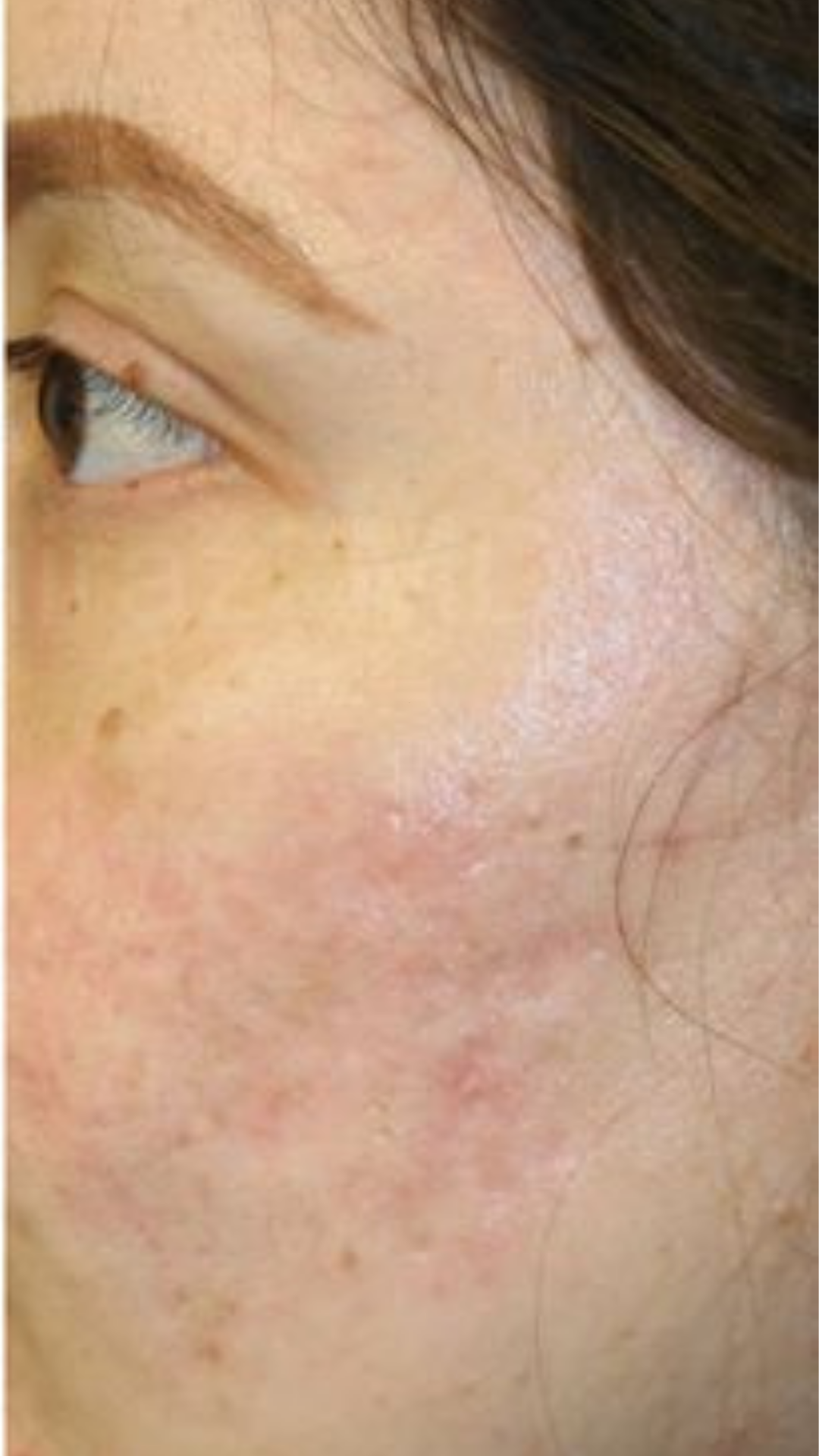 After acne scar removal