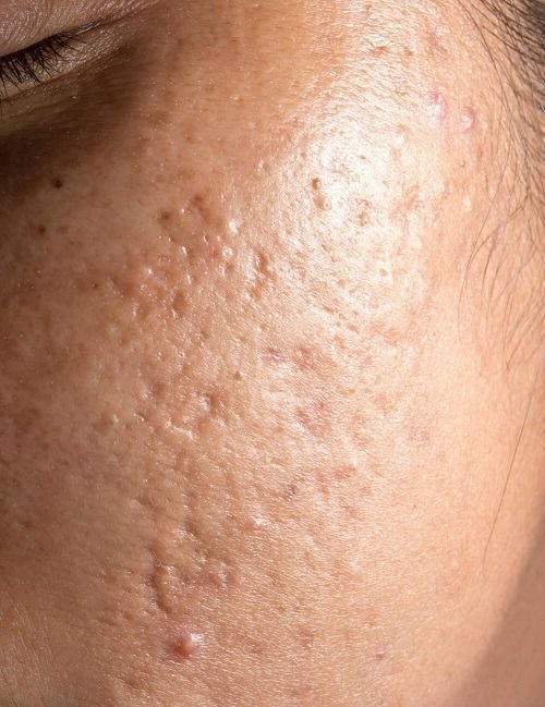 Acne Scar Removal