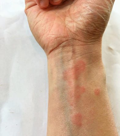 Lupus Management
