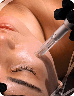 Microneedling with RF