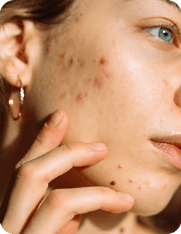 acne-scar-removal