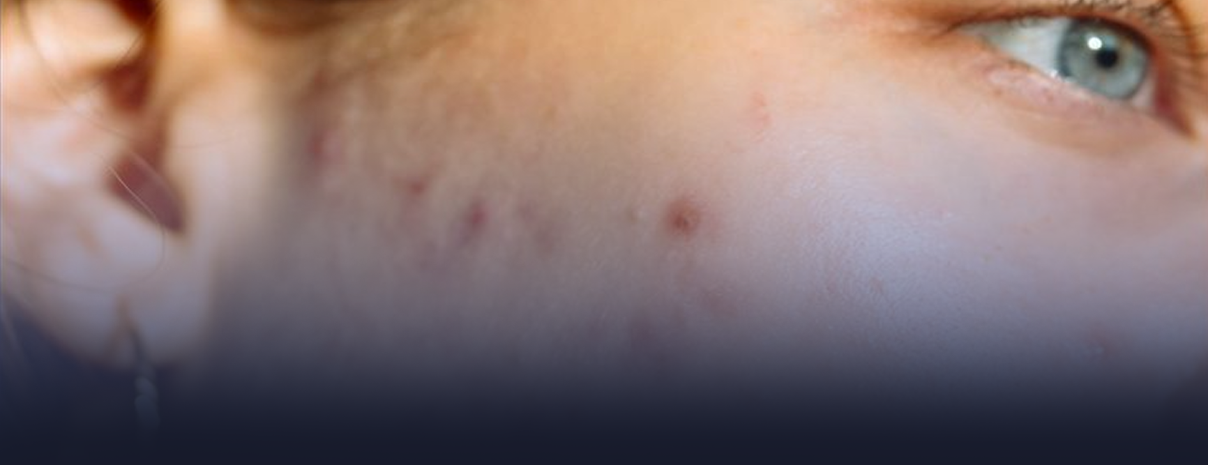 acnescarremoval