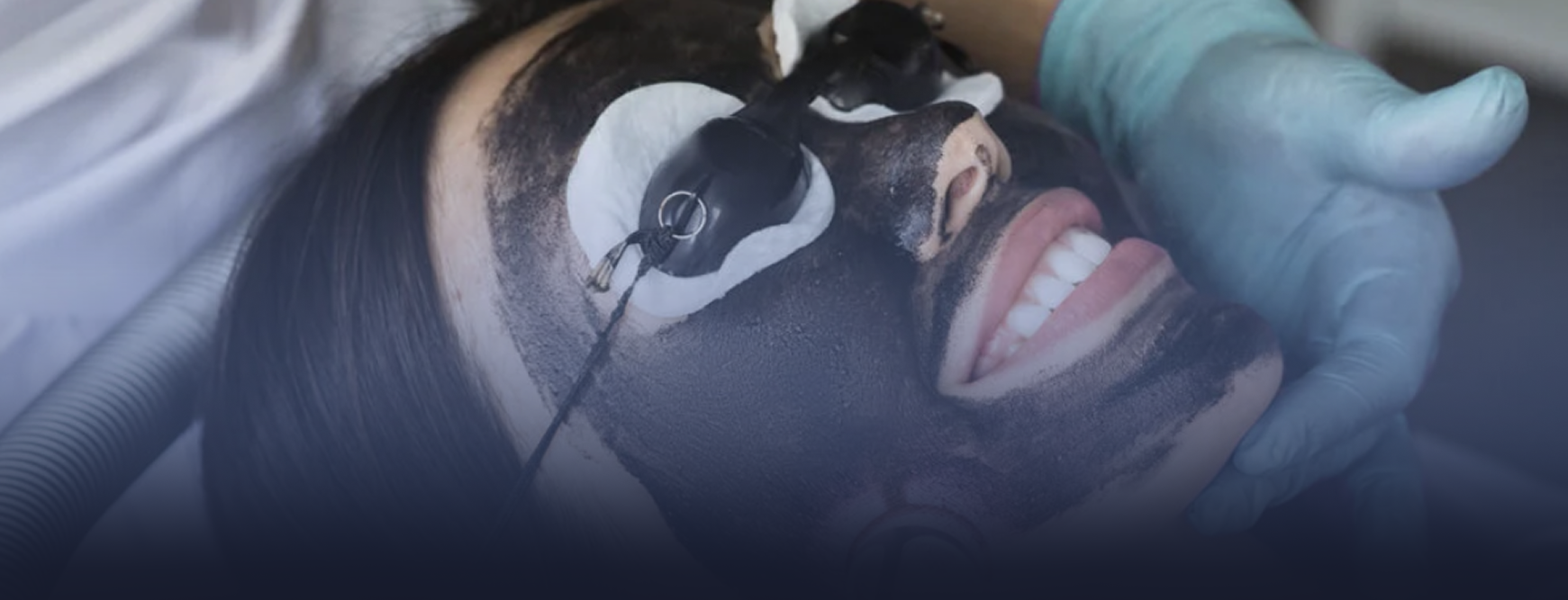 carbon-laser-facial